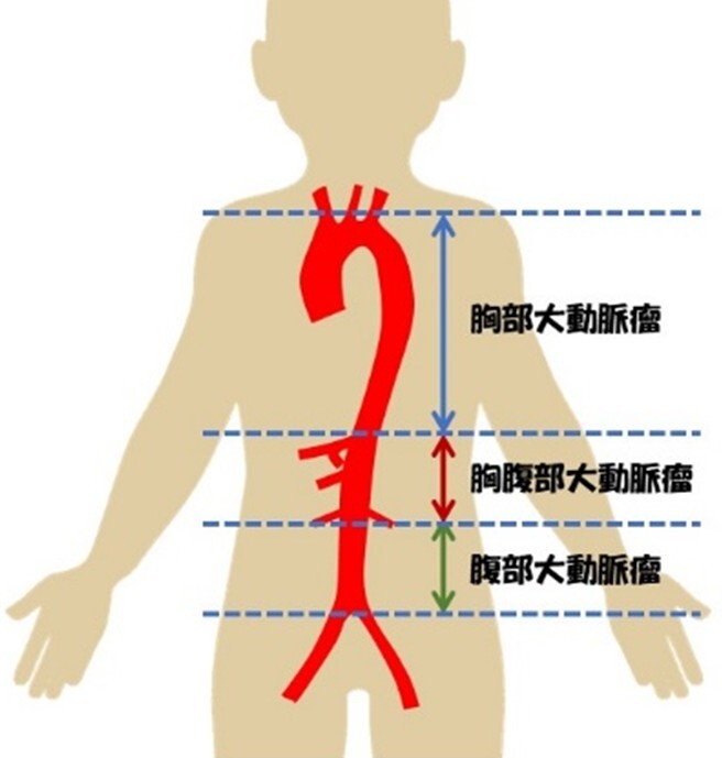 大動脈瘤とは2.jpg