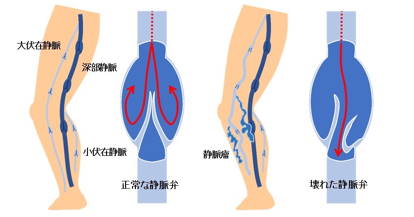下肢静脈瘤とは.jpg
