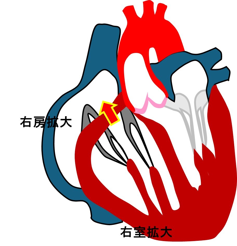 右房右室拡大.jpg