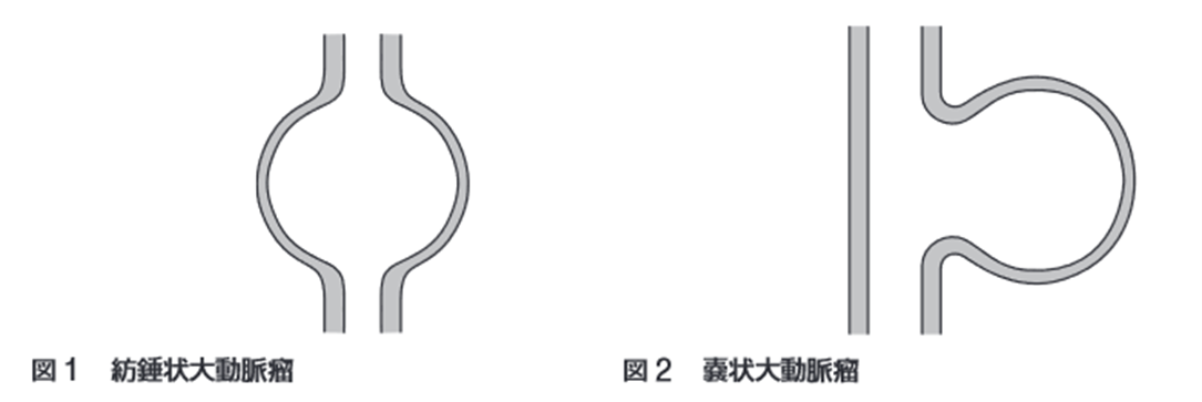大動脈瘤とは4.png