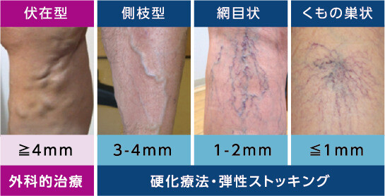 表在性静脈炎の診断