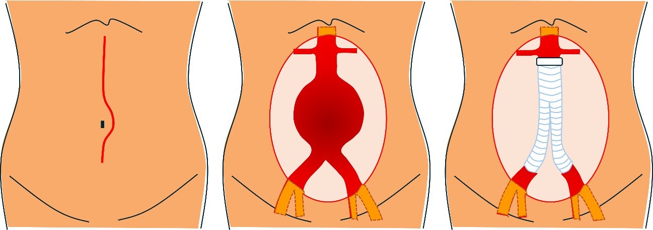 腹部大動脈瘤①.jpg