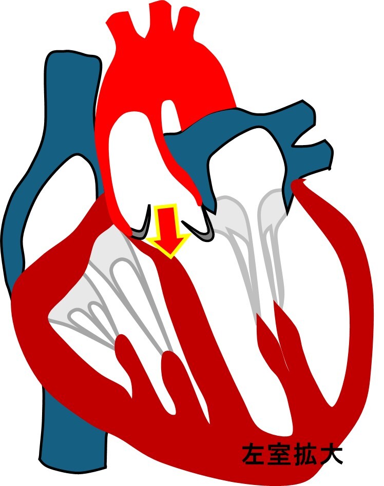 左室拡大.jpg