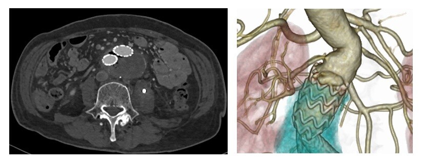 腹部ステントグラフト治療後の合併症とその治療2.jpg