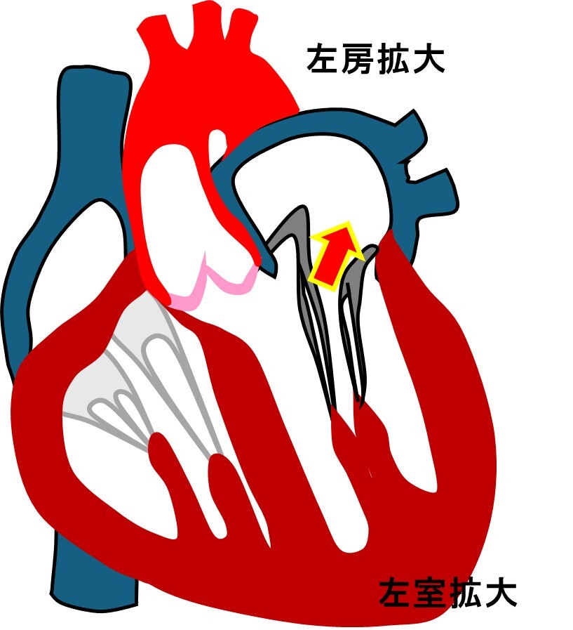 左房左室拡大.jpg
