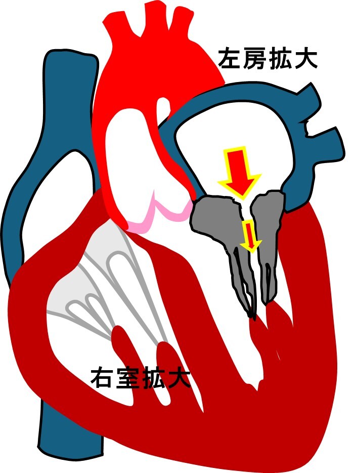 左房拡大_右室拡大.jpg