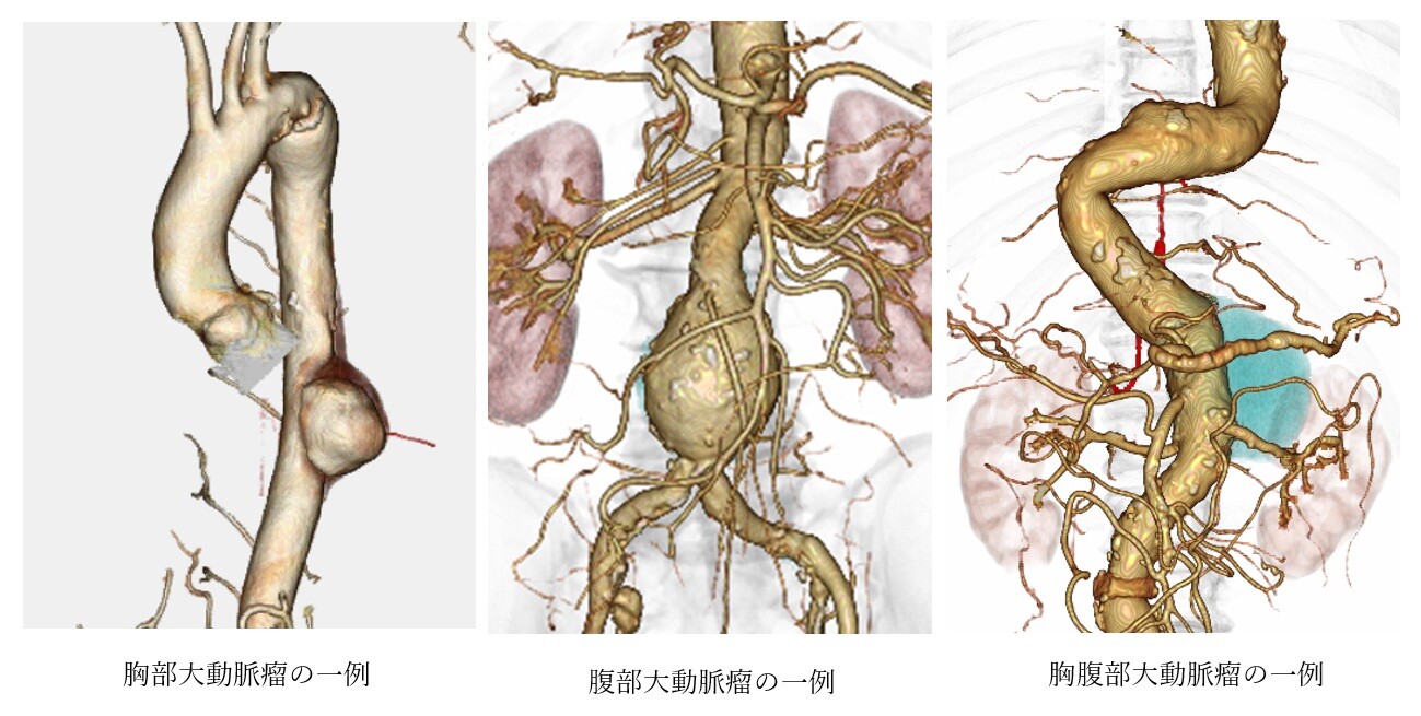 大動脈瘤とは3.jpg