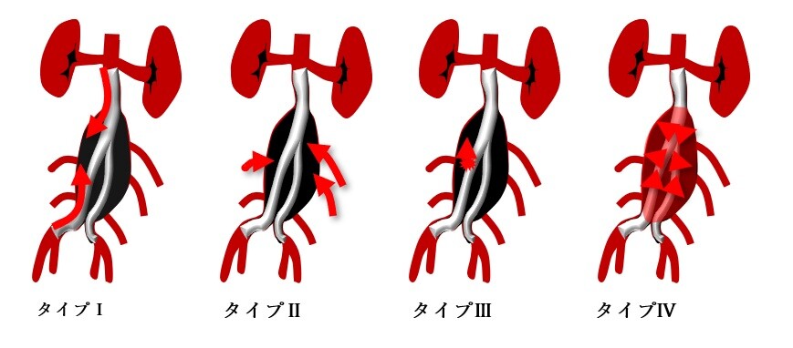 腹部ステントグラフト治療後の合併症とその治療1.jpg